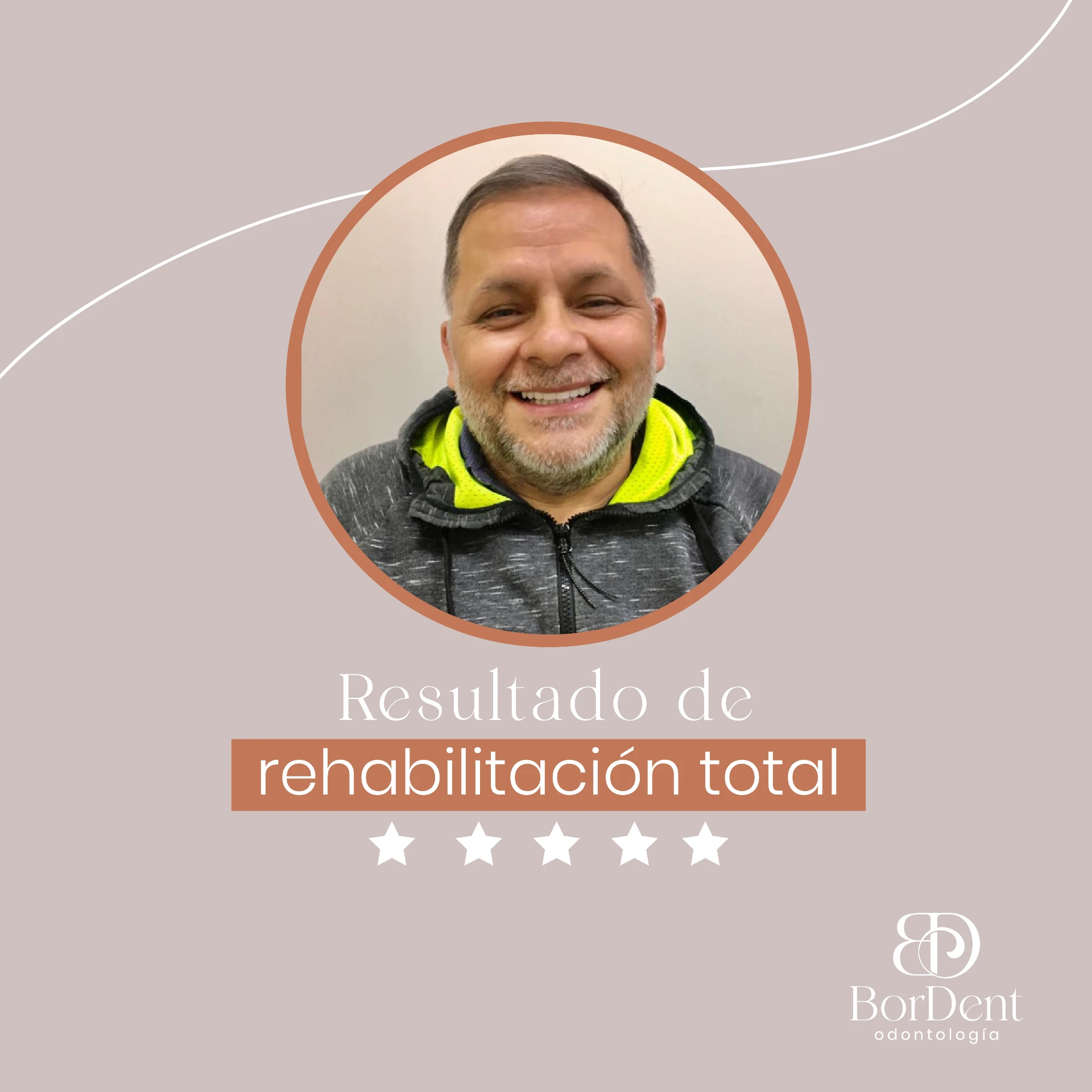 Caso real de rehabilitación dental en BorDent Odontología, Luque: antes y después