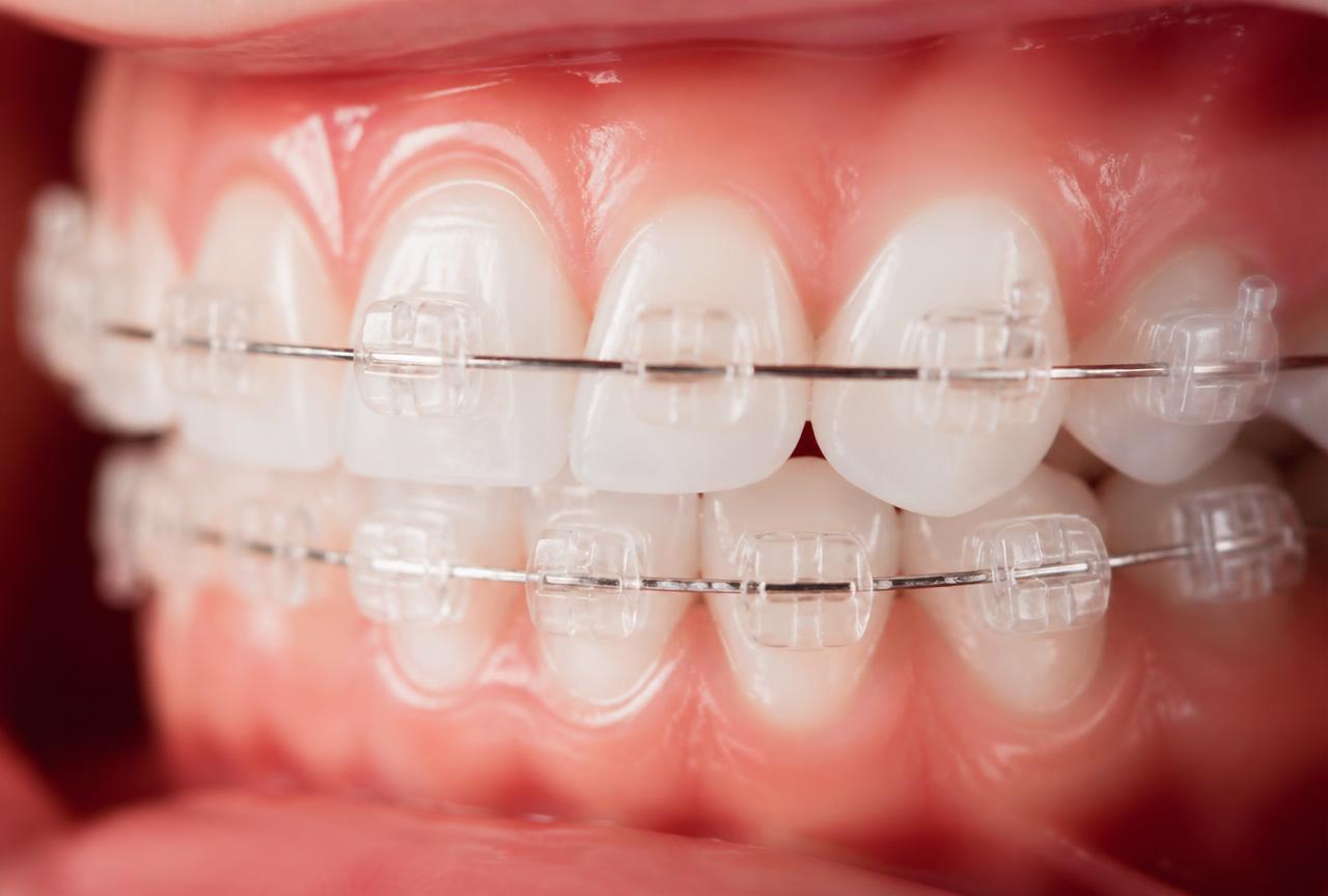 Brackets estéticos de zafiro transparentes sobre los dientes